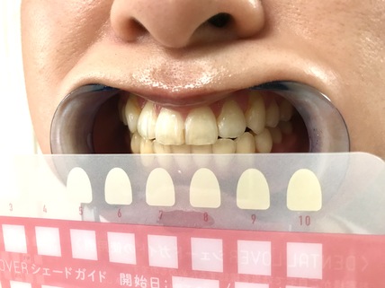 歯とシェードガイド